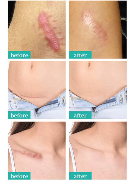 Maycheer scar And Stretch mark removal
