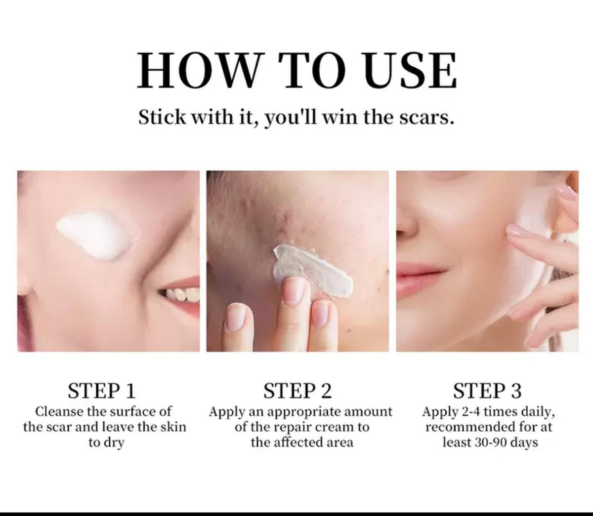Maycheer scar And Stretch mark removal