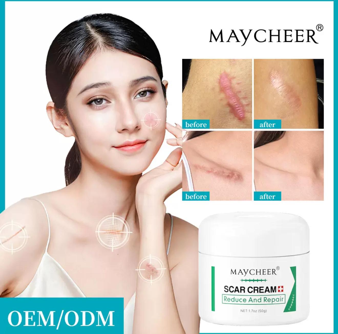 Maycheer scar And Stretch mark removal