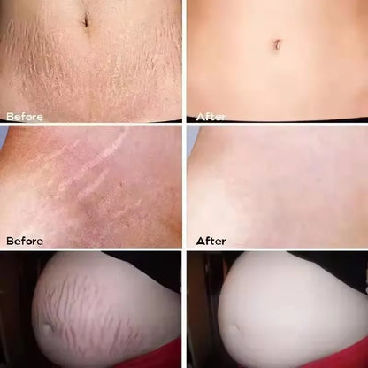 Maycheer Stretch Marks Repair Cream